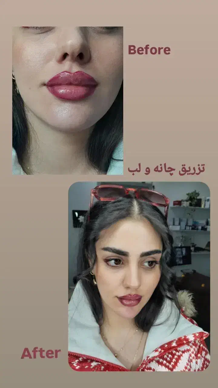 جشنواره یلدایی ژل و بوتاکس|خدمات آرایشگری و زیبایی|آمل, |دیوار