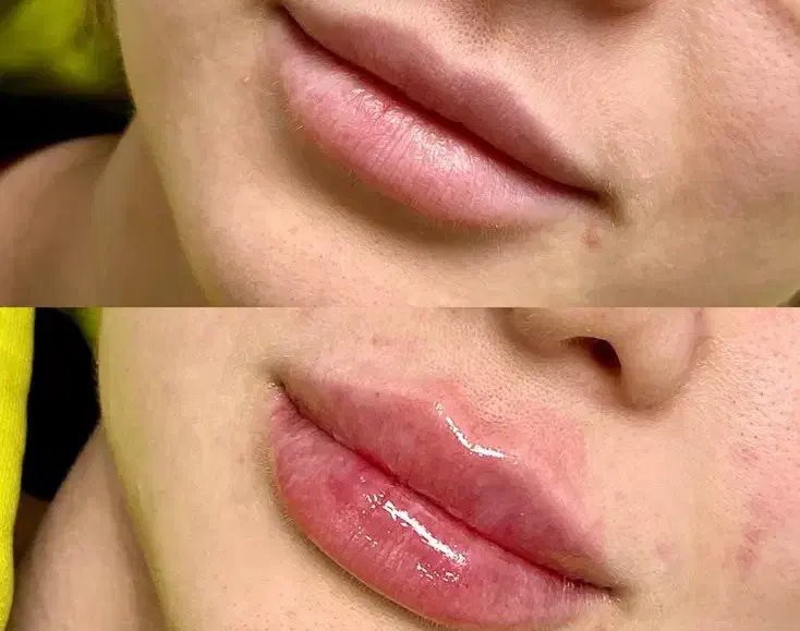 فیلر لب|خدمات آرایشگری و زیبایی|ماهدشت, |دیوار