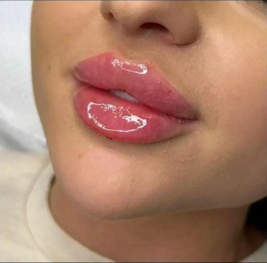 پزشک مزو ژل بوتاکس لب گونه چشم چانه زاویه فیلر prp|خدمات آرایشگری و زیبایی|کرج, گوهردشت|دیوار