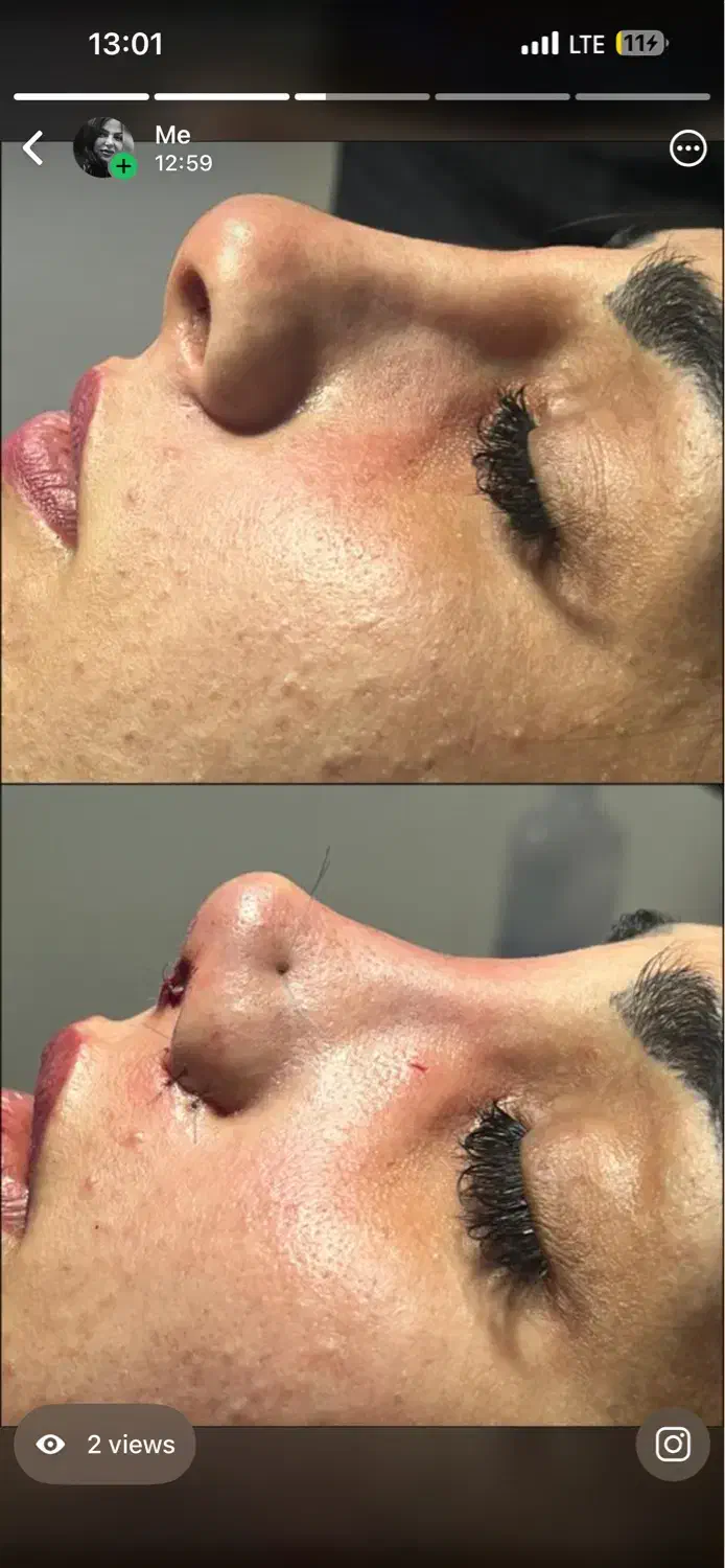 اف عمل زیبایی بینی|خدمات آرایشگری و زیبایی|دهدشت, |دیوار