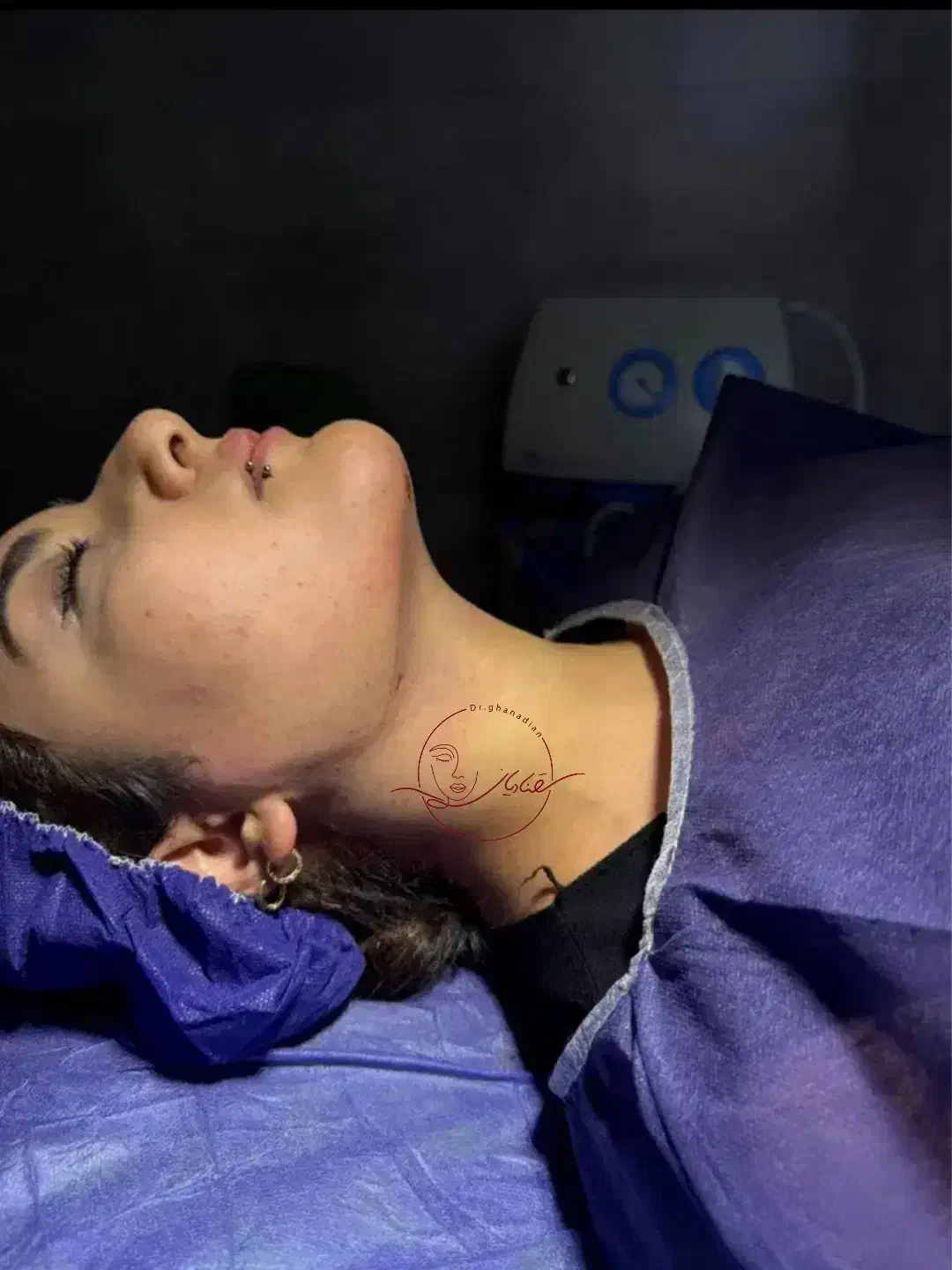 ساکشن غبغب بایوفیلر لیفت جوانساز اقساط چک|خدمات آرایشگری و زیبایی|اصفهان, سیچان|دیوار