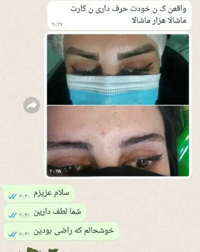 ریموو تتو با لیزر کیوسوییچ|خدمات آرایشگری و زیبایی|خرم‌آباد, |دیوار