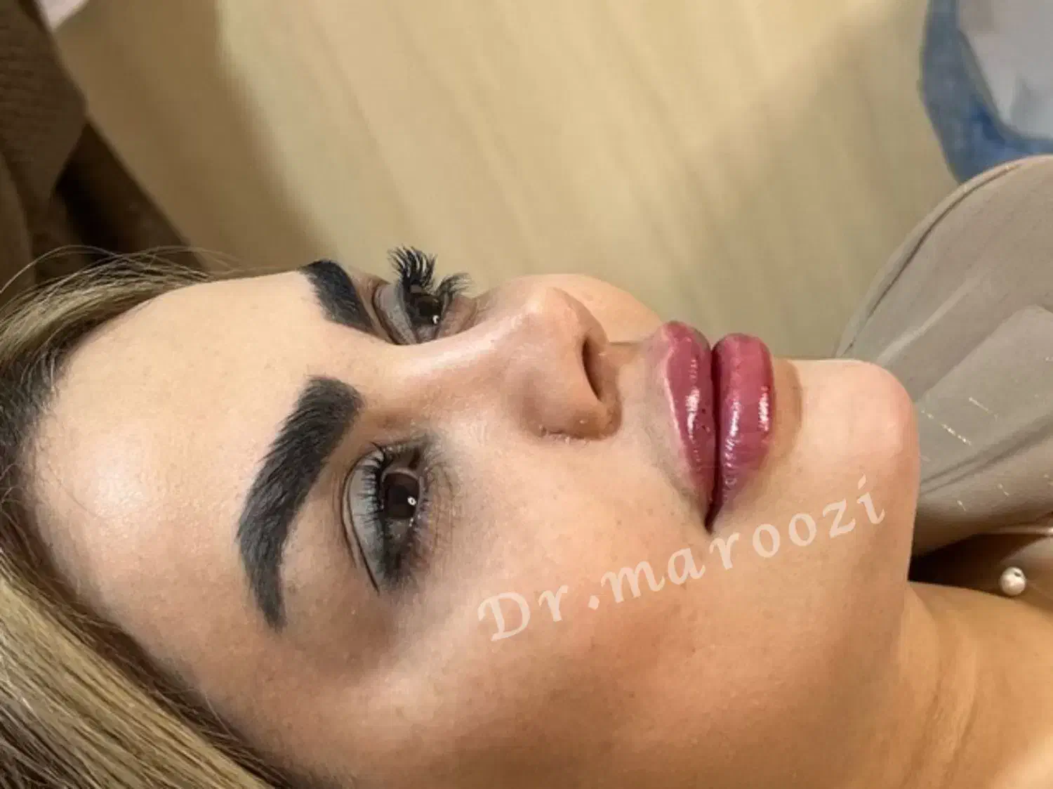 ژل لب فیلر بوتاکس مزو مادلینگ آنزیم بینی لیفتMD|خدمات آرایشگری و زیبایی|تهران, سردارجنگل|دیوار
