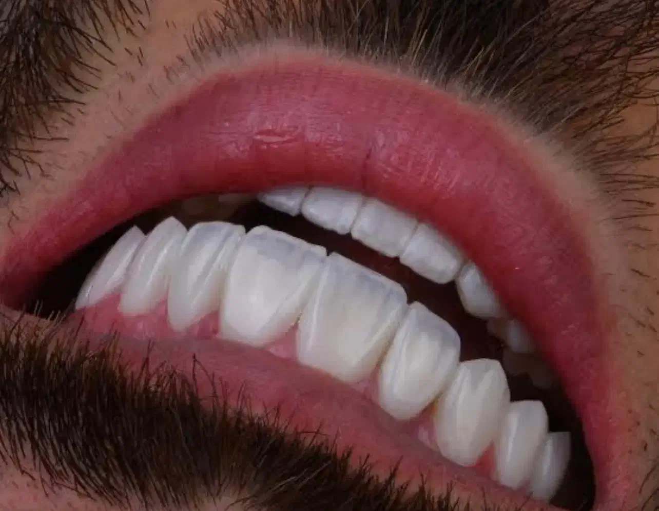 کامپوزیت دندان|خدمات آرایشگری و زیبایی|بوشهر, |دیوار