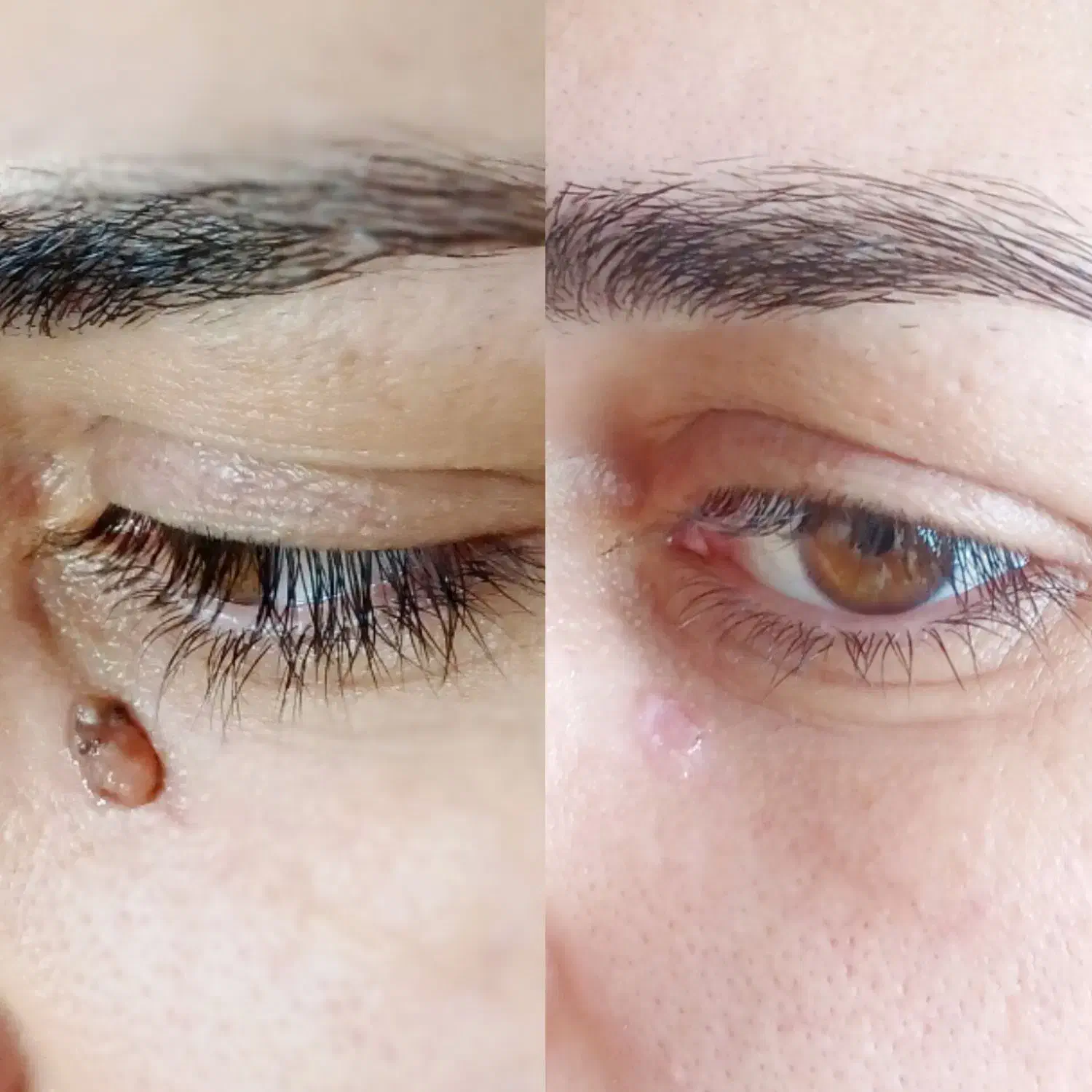 حذف خال ،میخچه ،زگیل فقط بامحلول گیاهی|خدمات آرایشگری و زیبایی|خمینیشهر, |دیوار