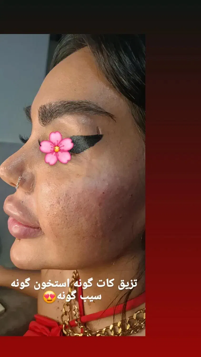 تزریق ژل بوتاکس|خدمات آرایشگری و زیبایی|شیراز, نصرآباد|دیوار
