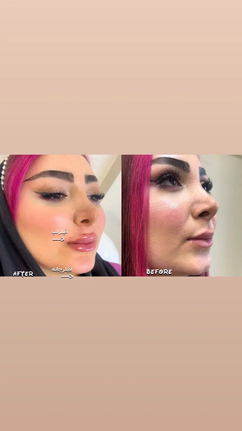 نیاز به مدل برای تزریق فیلر فول فیس(لب،زاویه،چونه)|خدمات آرایشگری و زیبایی|آستانه اشرفیه, |دیوار