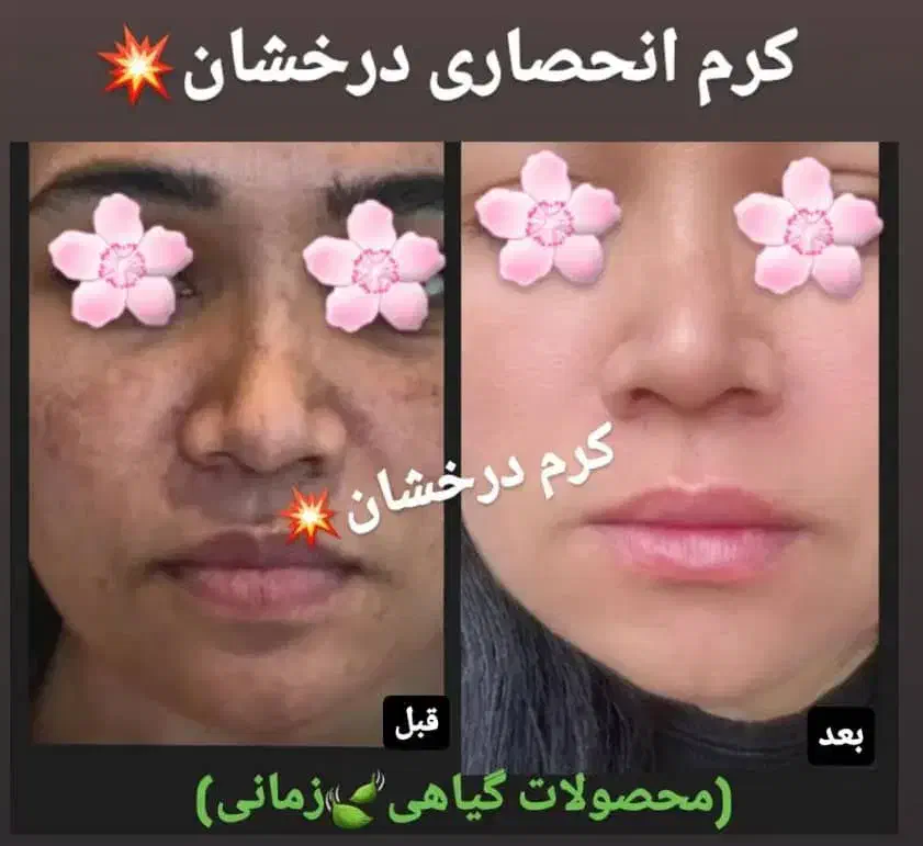 کرم ضدلک و روشن کننده درخشان(بدون بازگشت)|حراج|مشهد, بهشت|دیوار