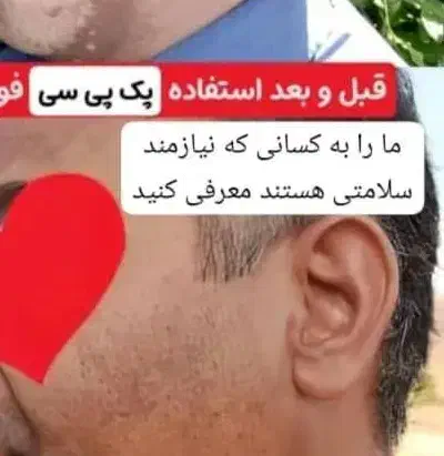 پوست چرب و جای جوش و آکنه|آرایشی، بهداشتی، درمانی|شیراز, لشکری|دیوار