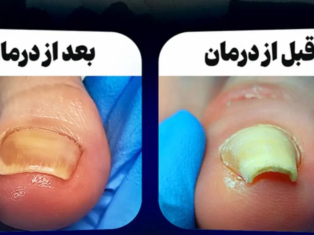 درمان بیماری ناخن ساختمان پزشکان رز پیروزی ۳۸|خدمات آرایشگری و زیبایی|مشهد, چهارچشمه|دیوار