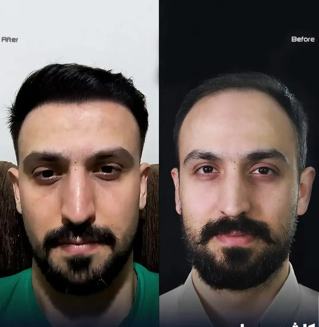 اقتصادی ترین کلینیک کاشت مو و ابرو در تهران/ اقساط|خدمات آرایشگری و زیبایی|تهران, سعادت‌آباد|دیوار