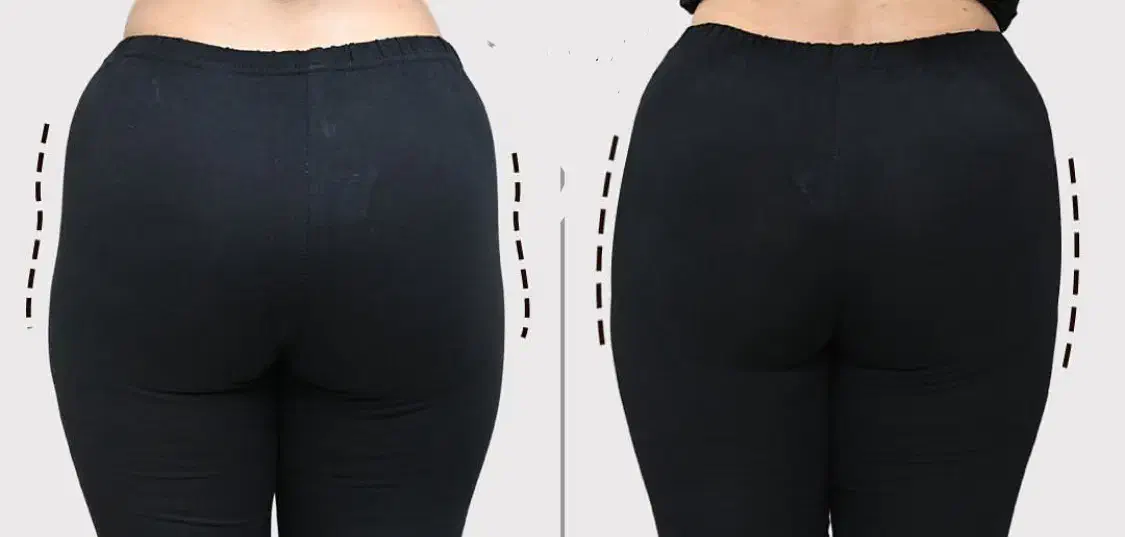 ساکشن چربی ترانسفر به هیپ دیپ و باسن فیلربادی غبغب|خدمات آرایشگری و زیبایی|تهران, شهرک صدرا|دیوار