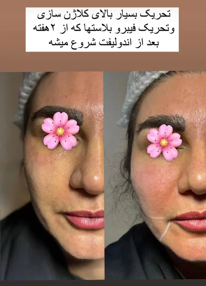 درمان افتادگی غبغب بازو وشکم وصورت|خدمات آرایشگری و زیبایی|قم, سالاریه|دیوار
