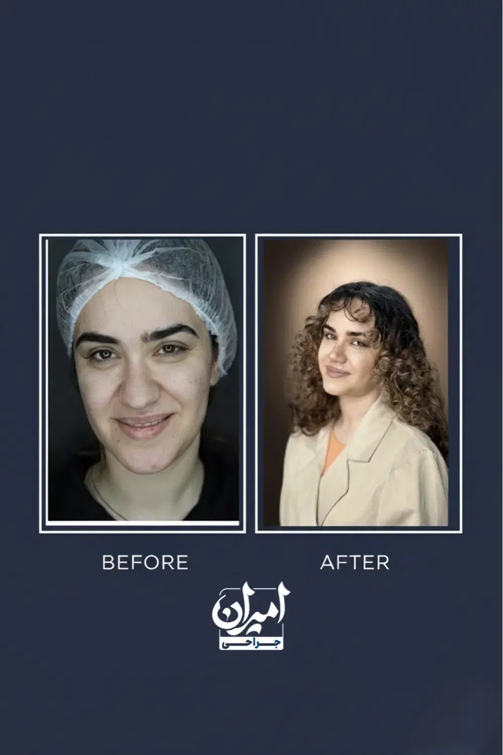 جراحی بینی با شرایط ویژه|خدمات آرایشگری و زیبایی|مرودشت, شهرک مهدیه|دیوار