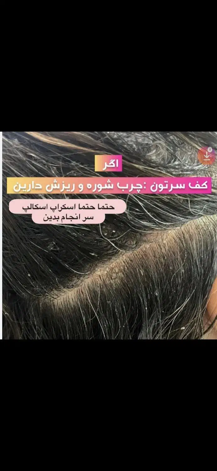 درمان قطعی موخوره و ریزش مو رایگان شد.|خدمات آرایشگری و زیبایی|رشت, کوی بیانی|دیوار