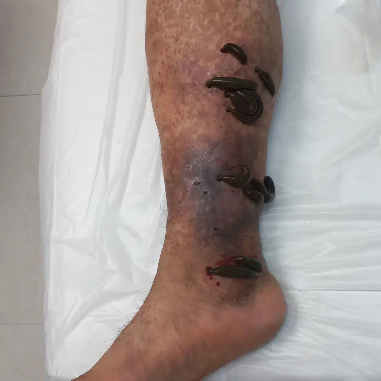 حجامت ،فصدوزالو،سم زدا ویونیزاسیون ماساژ درمانی|خدمات آرایشگری و زیبایی|سنندج, |دیوار