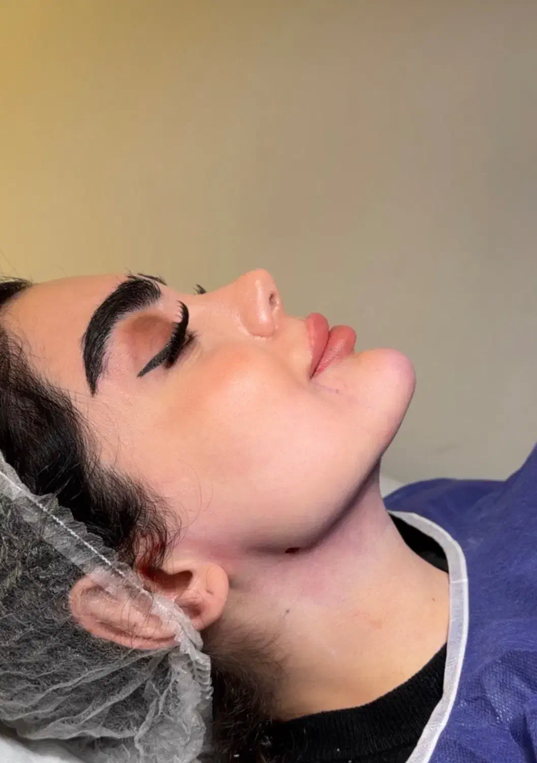 وی لاین تکنیک انحصاری کیلینیک مهرزاد ساکشن غبغب|خدمات آرایشگری و زیبایی|تهران, الهیه|دیوار