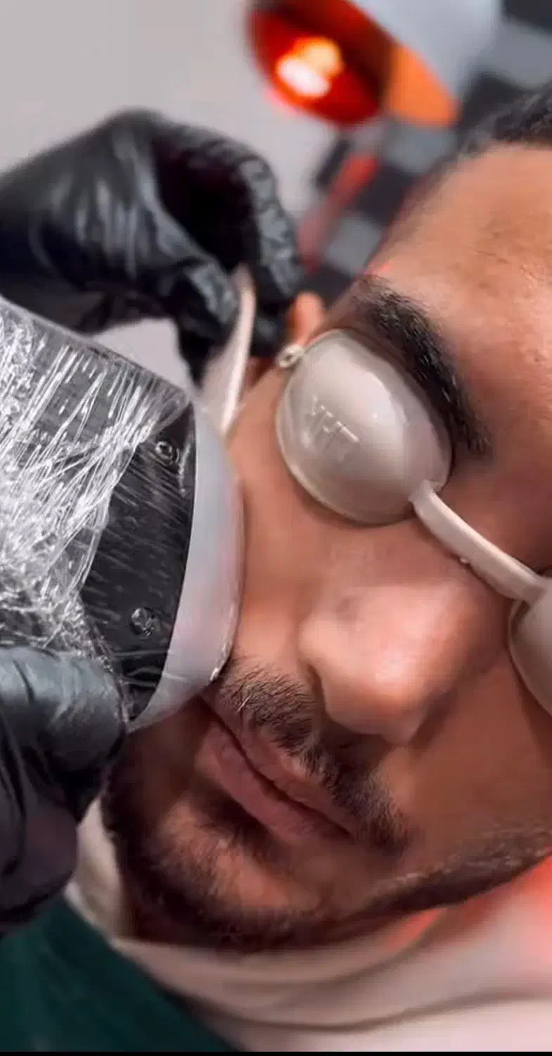 خدمات فیشال و لیزر تخفیف بلک فرایدی|خدمات آرایشگری و زیبایی|قائمشهر, |دیوار