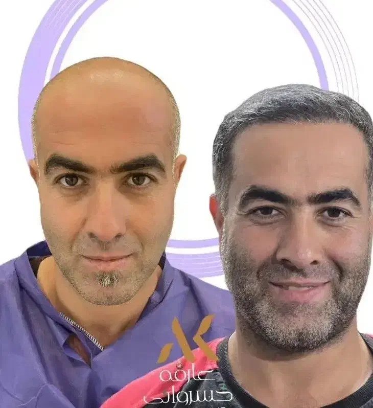 کاشت مو با بالاترین تراکم|خدمات آرایشگری و زیبایی|لامرد, |دیوار