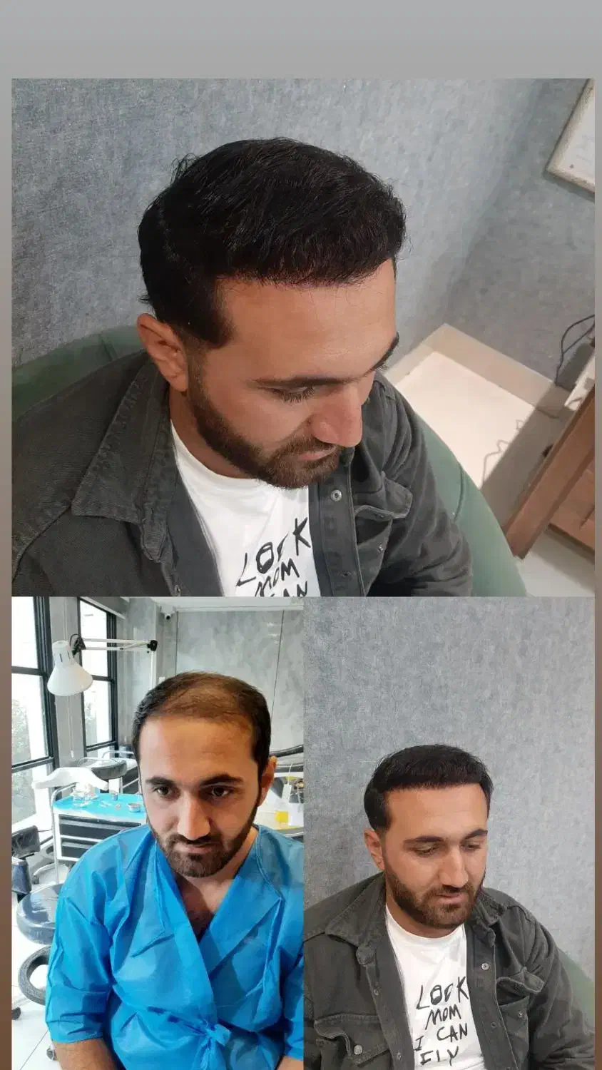 کاشت مو تخصصی|خدمات آرایشگری و زیبایی|تبریز, |دیوار