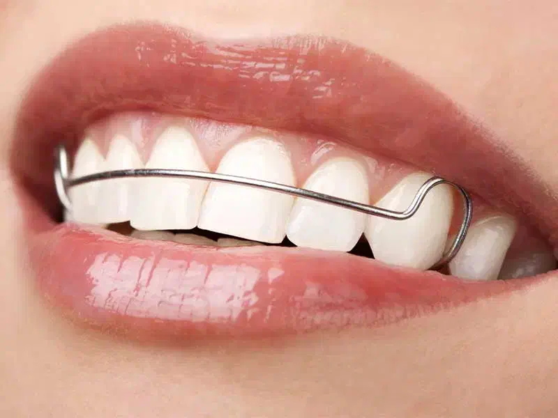 سیم پیچی ( ارتودنسی) دندان کودکان|خدمات آرایشگری و زیبایی|زاهدان, |دیوار