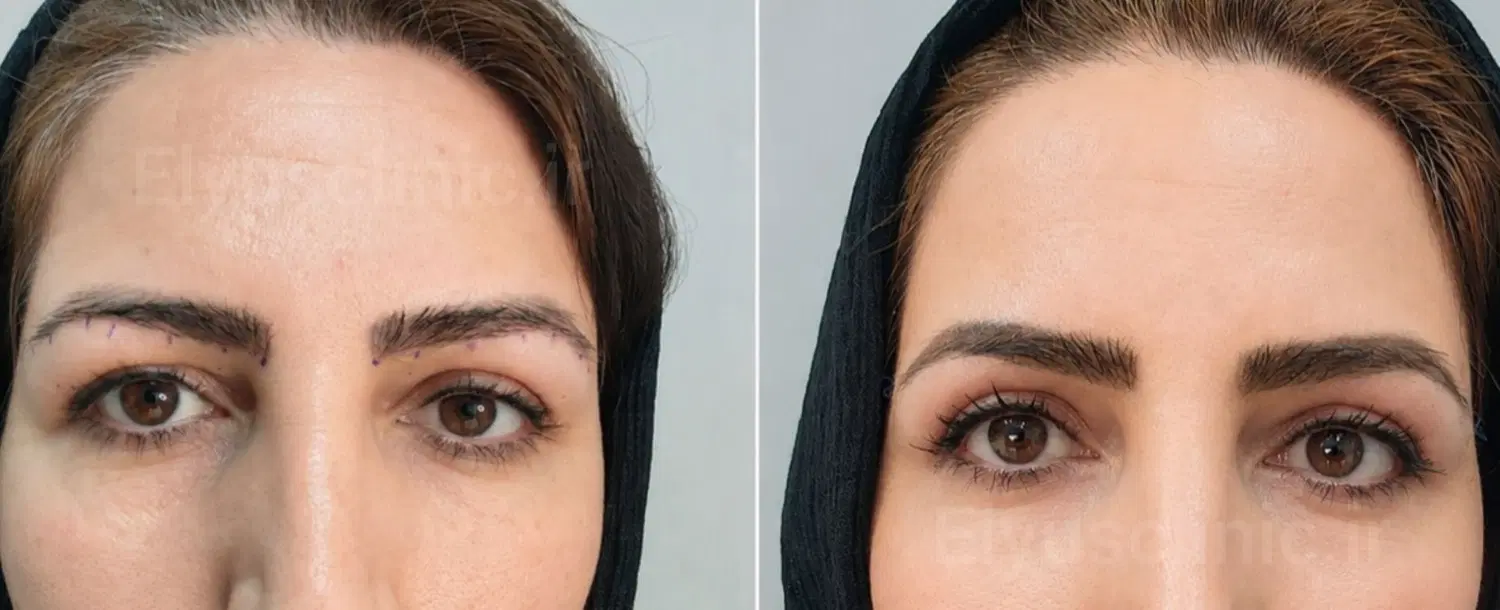 بلفارو پلاستی ۷ تومن کاشت ابرو و مو ساکشن|خدمات زیبایی و سلامت|کرج, اتحاد|دیوار