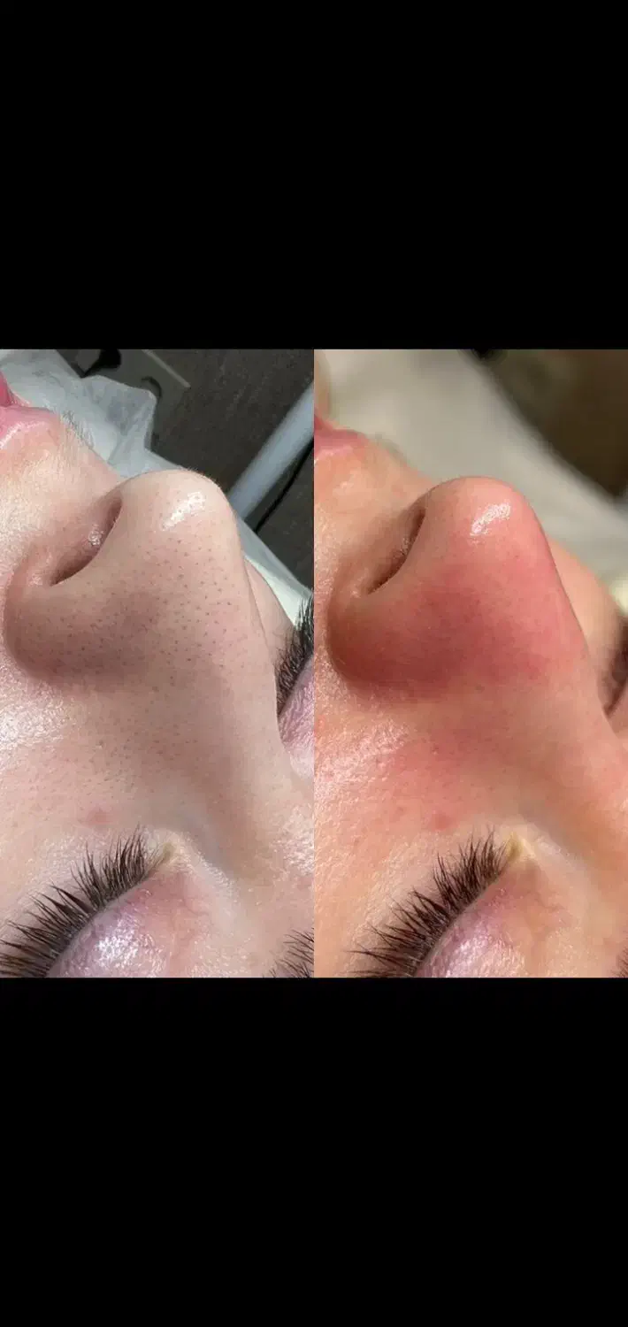 پاکسازی تخصصی  پوست|خدمات آرایشگری و زیبایی|دهدشت, |دیوار