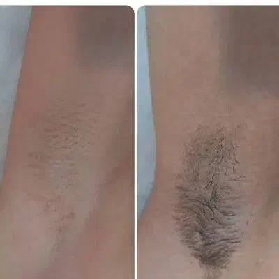 اپیلاسیون .مومک|خدمات آرایشگری و زیبایی|رفسنجان, |دیوار