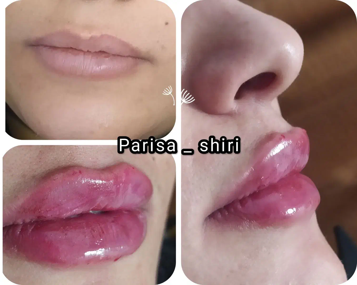 ژل، فیلر لب ۵۰۰،آنزیم ۳۵۰،زاویه ،بوتاکس۴۵۰|خدمات آرایشگری و زیبایی|قم, تولید دارو و یخچال|دیوار