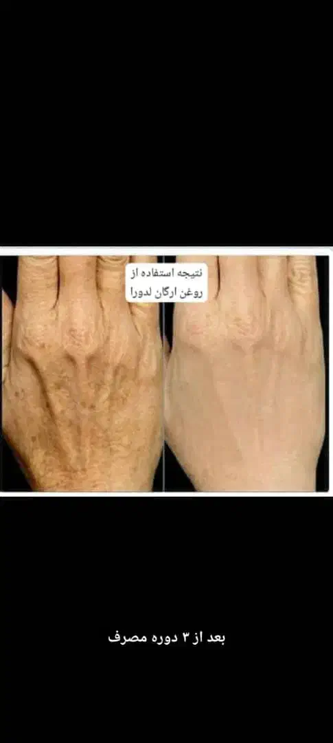 کرم ضد لک دست و صورت|آرایشی، بهداشتی، درمانی|شیراز, زیباشهر|دیوار