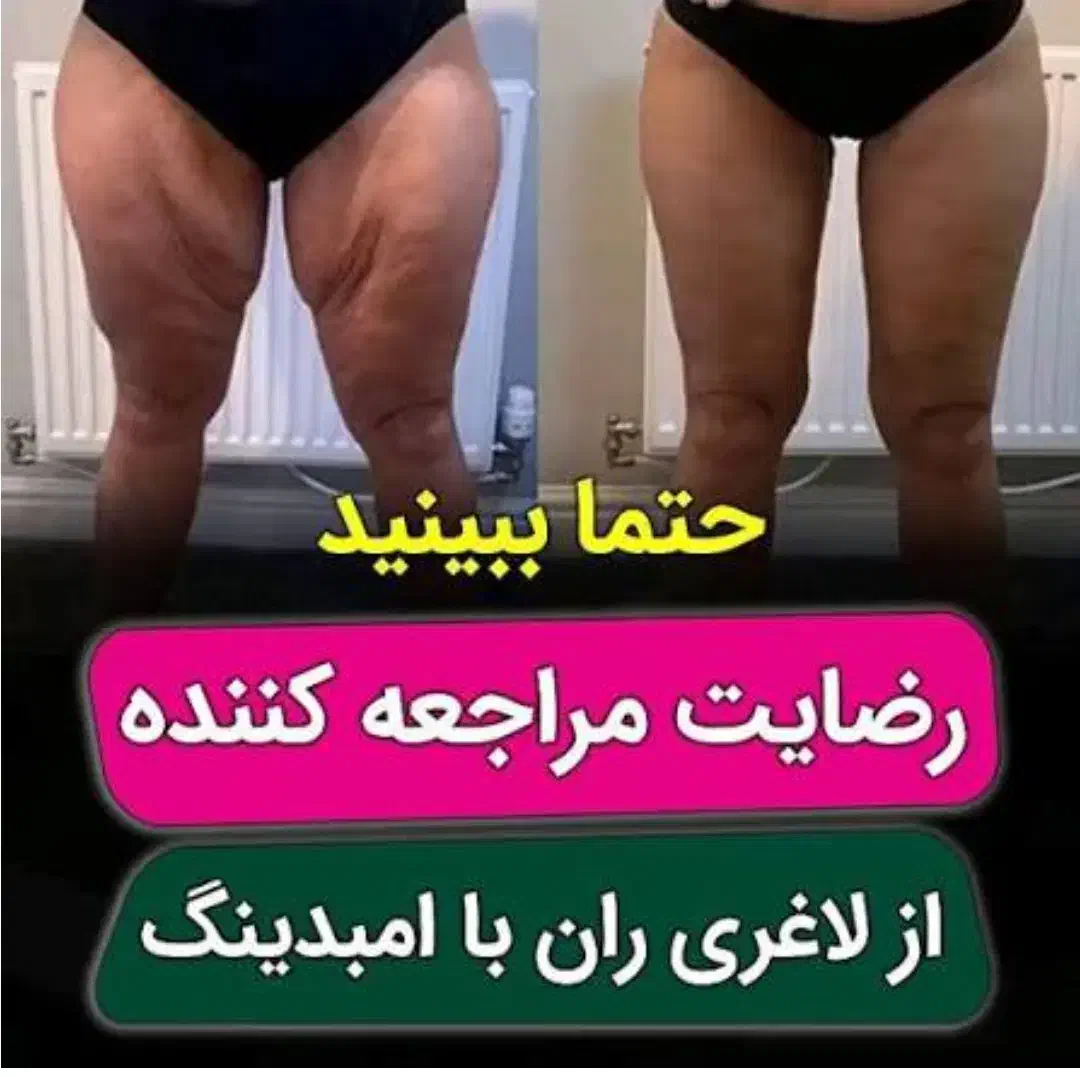 لاغری و لیفت با روش جدید امبدینگ|پزشکی|تهران, نیلوفر|دیوار