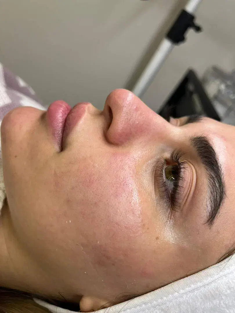 فیشال پوست جوانسازی و آبرسانی و رفع جوش و جای جوش|خدمات آرایشگری و زیبایی|اصفهان, رکن الدوله غربی|دیوار