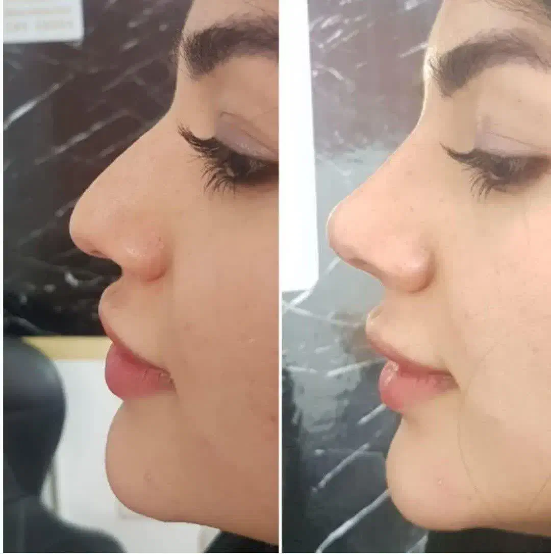 جشنواره تخفیف عمل تیپ پلاستی وبلفارو ابدو ساکشن|خدمات آرایشگری و زیبایی|مشهد, توس (بلوار توس)|دیوار