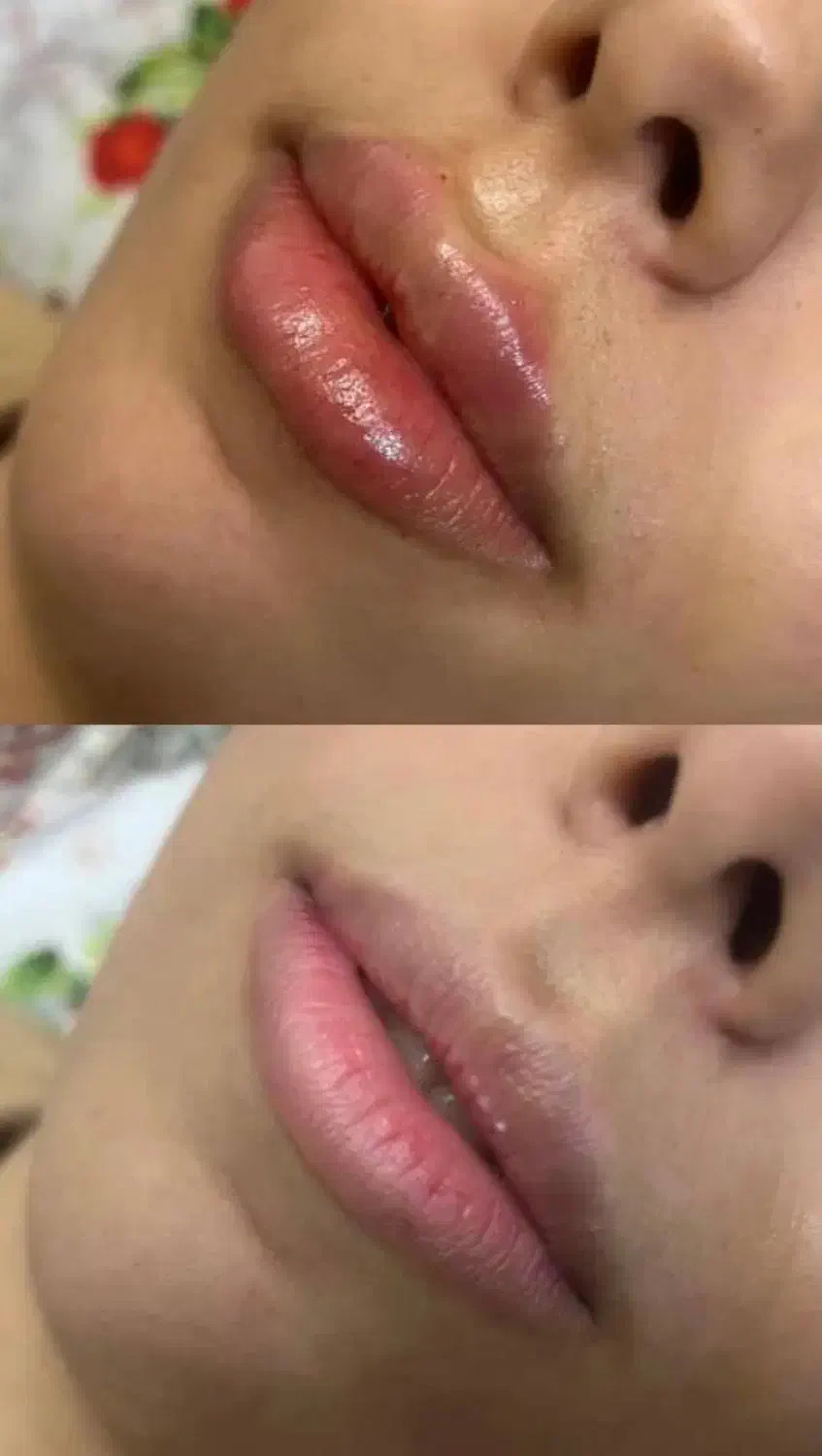 تزریق فیلر و بوتاکس|خدمات آرایشگری و زیبایی|قرچک, مهدیه|دیوار