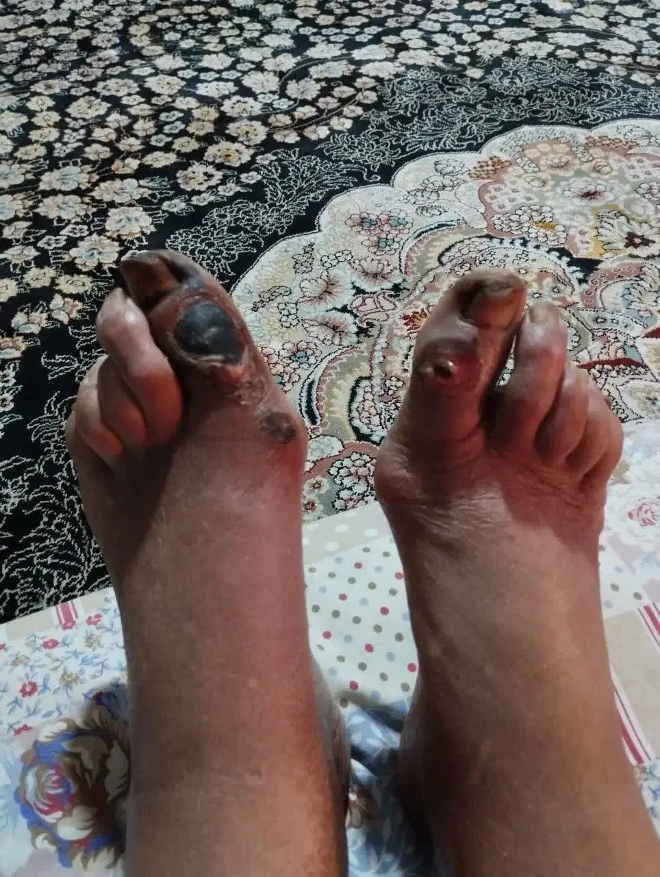 درمان ریشه ای دیابت قطع قرص و انسولین|خدمات آرایشگری و زیبایی|ملایر, |دیوار