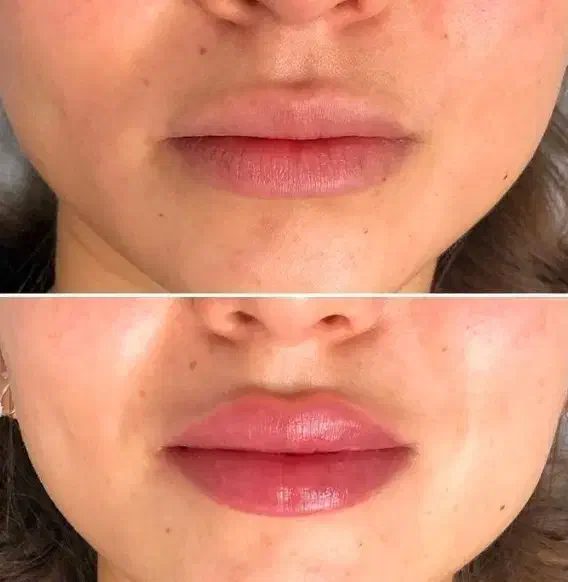انجام خدمات زیبایی ،بوتاکس ،فیلر،مروتراپی ،مزوژل و|خدمات آرایشگری و زیبایی|تهران, نیروی هوایی (پیروزی)|دیوار