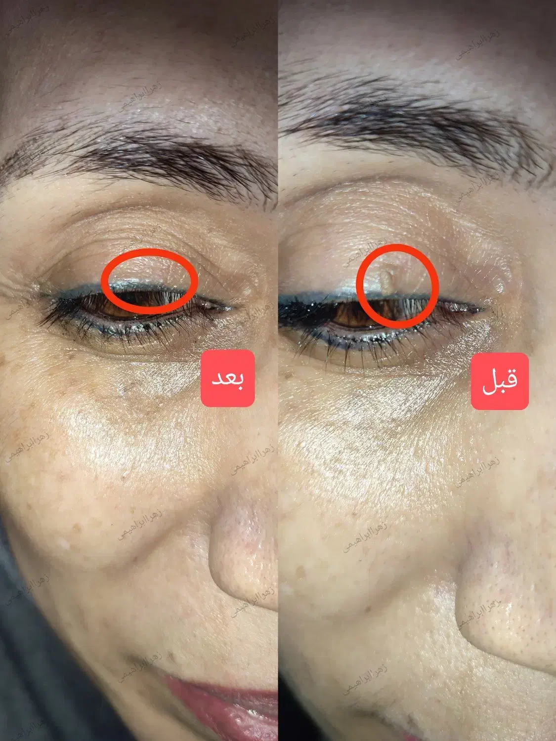 لیزر خال /میخچه زگیل/ ژل بوتاکس|خدمات آرایشگری و زیبایی|قم, صفائیه|دیوار