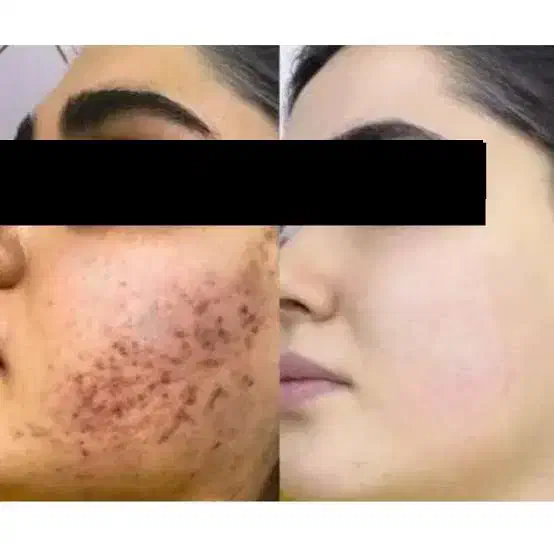 فرمول کرم معجزه،فرمول کرم وی آی پی|آرایشی، بهداشتی، درمانی|شادگان, |دیوار