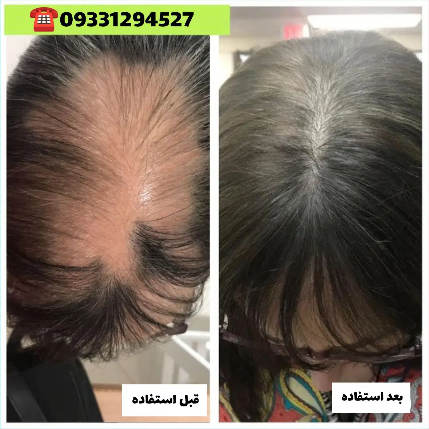 رویش مجدد مو تضمینی و قسطی|آرایشی، بهداشتی، درمانی|رشت, بلوار گیلان|دیوار