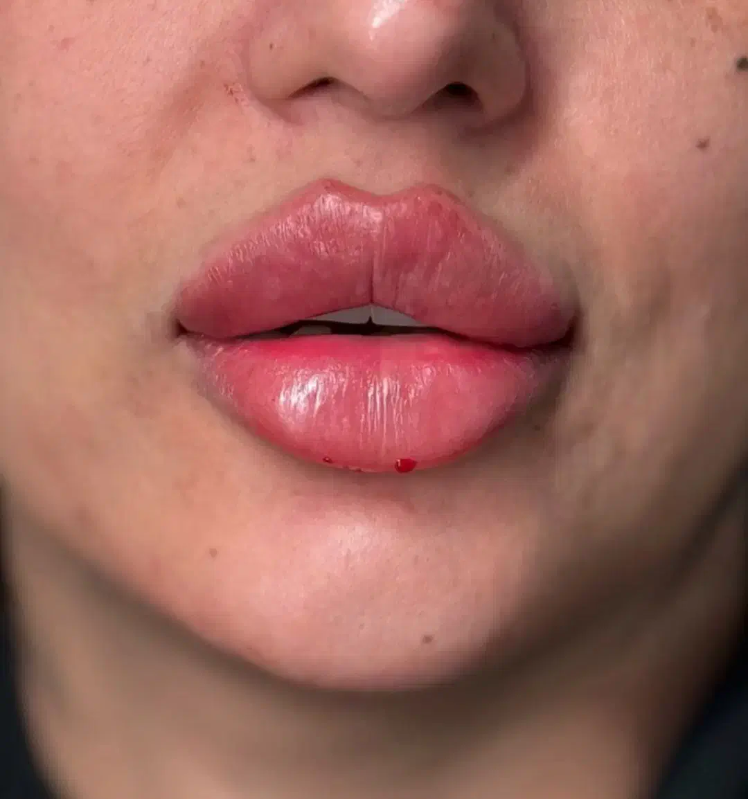 خدمات فیلروبوتاکس|خدمات آرایشگری و زیبایی|سنندج, |دیوار