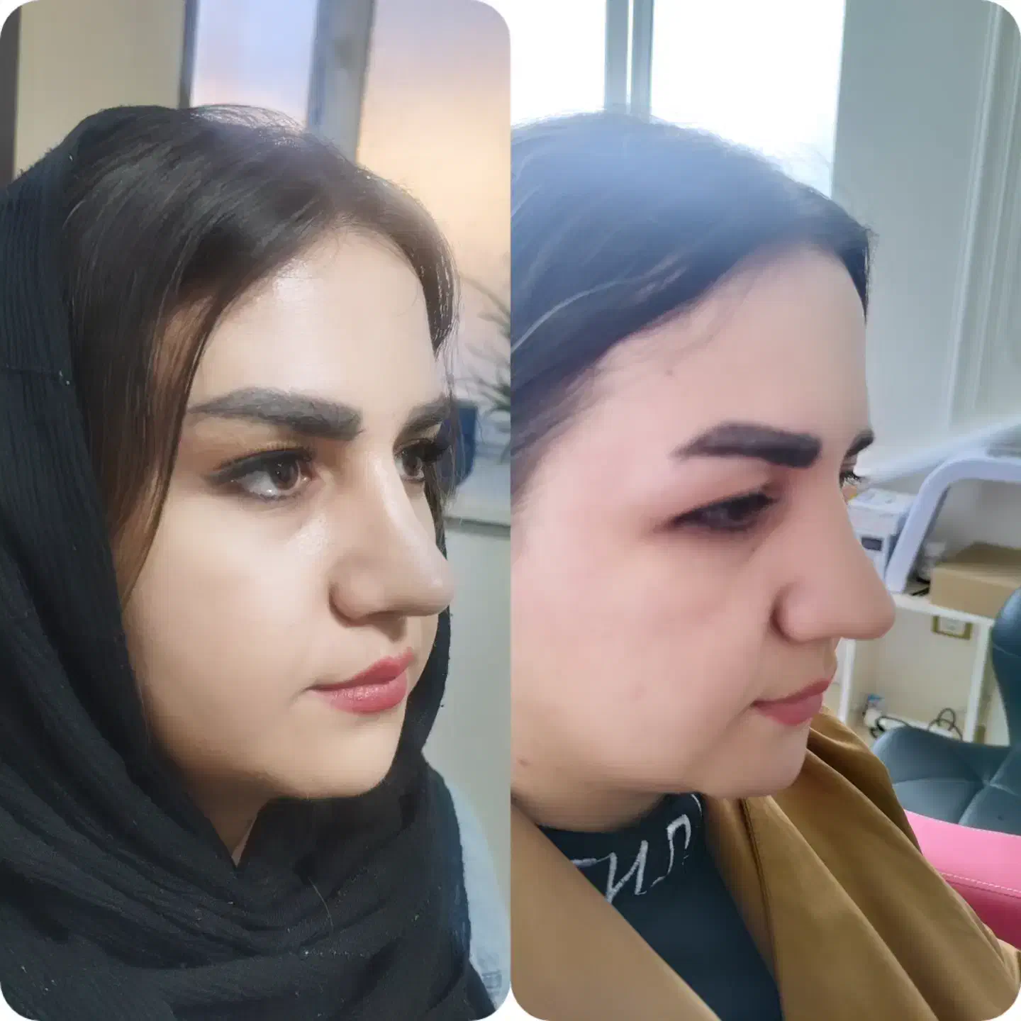 لیفت شقیقه وگونه با جراحی|خدمات آرایشگری و زیبایی|بوکان, |دیوار