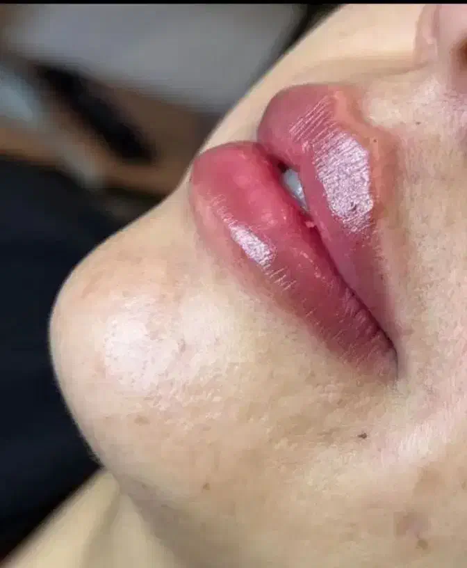 تزریق ژل لب،بوتاکس،مزو تراپی،هایفو تراپی،لیزر|خدمات آرایشگری و زیبایی|فردیس, شهرک ارم|دیوار
