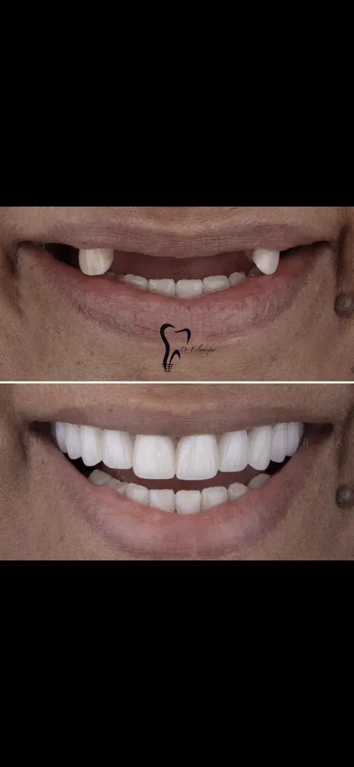 وام دندانپزشکی ایمپلنت|خدمات آرایشگری و زیبایی|رباط‌کریم, رباط‌کریم|دیوار