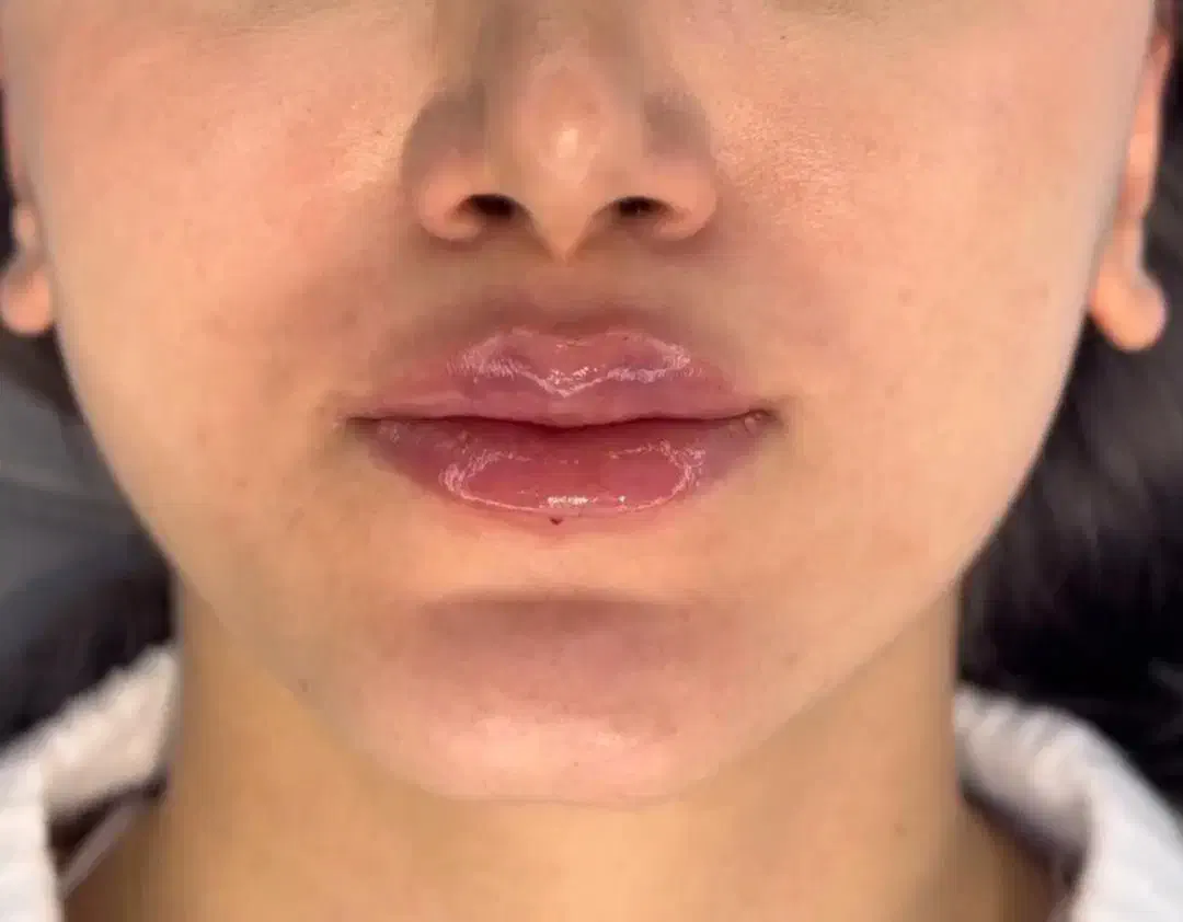 نیازمند مدل رایگان فیلر لب|خدمات آرایشگری و زیبایی|ساری, |دیوار