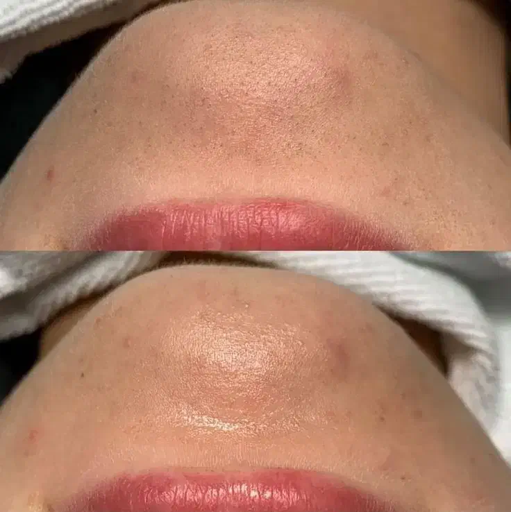 جشنواره پاییزه جوانسازی پوست فیشال پی ارپی اگزوزم|خدمات آرایشگری و زیبایی|مشهد, کوشش|دیوار