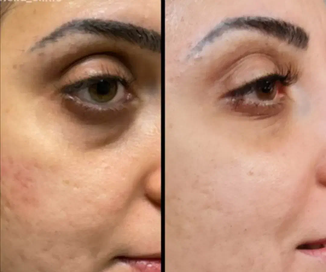 فیلرزیر چشم، زاویهفک، لیفت شقیقه، بوتاکس، لب نچرال|خدمات آرایشگری و زیبایی|مشهد, سرافرازان|دیوار