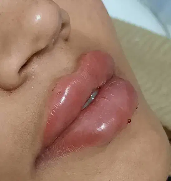 مدل ژل و بوتاکس|خدمات آرایشگری و زیبایی|قم, باسکول|دیوار