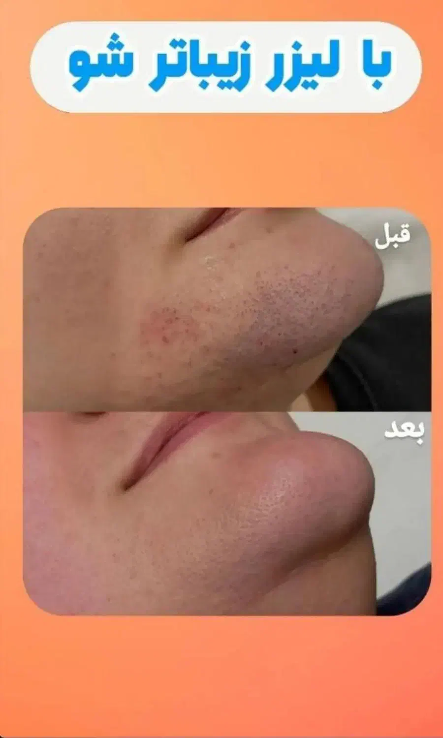 لیزرموهای زائد هنوزباقیمت قبل توعکسهارضایتهاروببین|خدمات آرایشگری و زیبایی|شیراز, ستارخان|دیوار