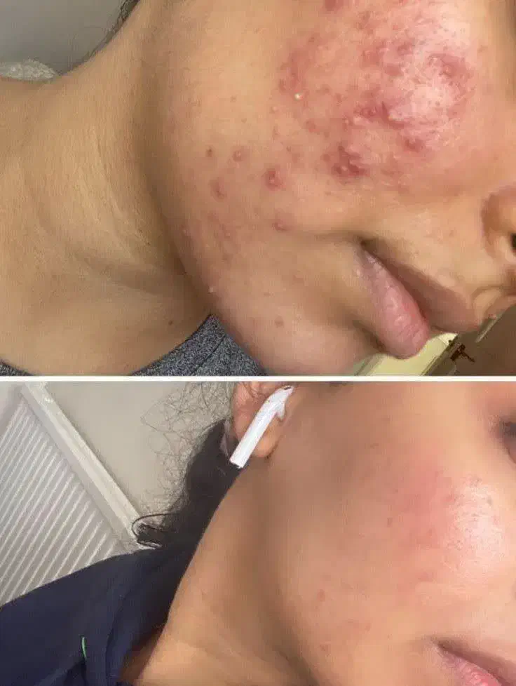 هرگز بوتاکس نکنید|آرایشی، بهداشتی، درمانی|تهران, ولنجک|دیوار