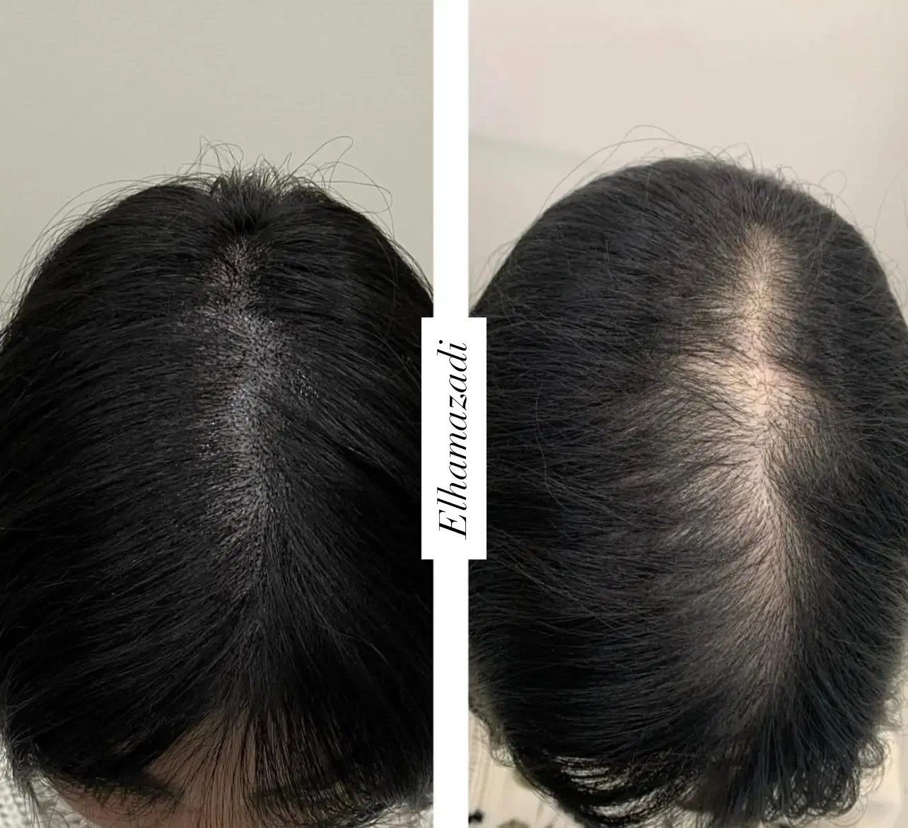 میکرواسکالپ سر/شیدینگ لب/رفع کبودی لب/بنمژه|خدمات آرایشگری و زیبایی|شیراز, معالی‌آباد|دیوار